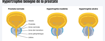 Visuel Prostate qui appuie sur la vessie