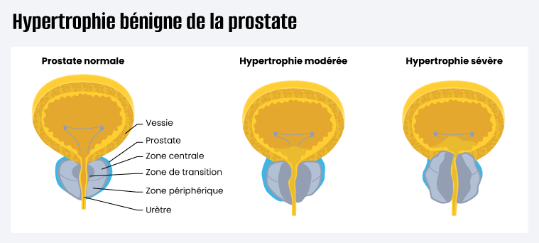 Visuel Prostate qui appuie sur la vessie